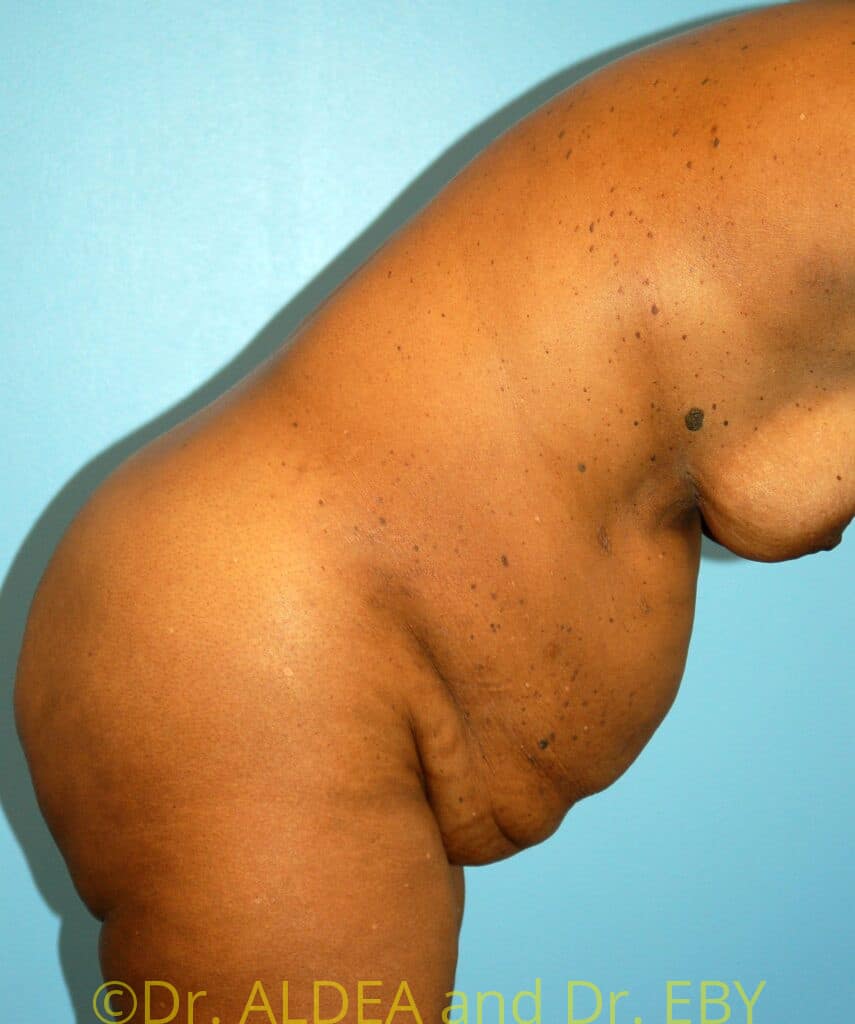 Before Image: Tummy Tuck #548 - other