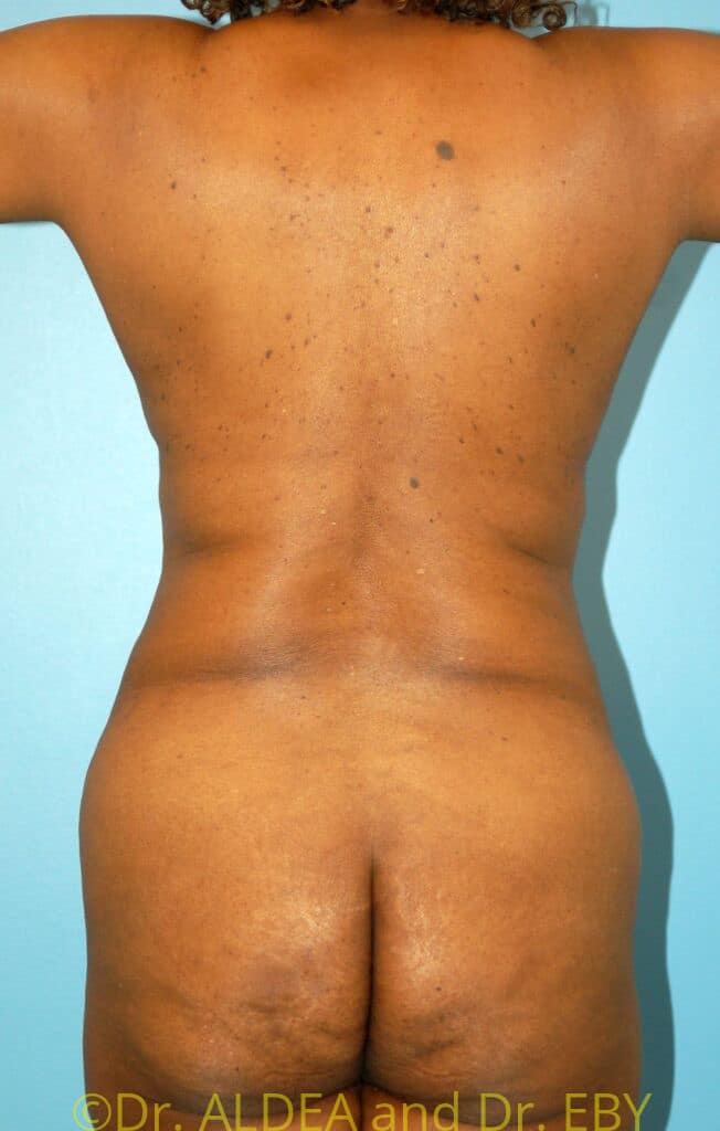 Before Image: Tummy Tuck #548 - back