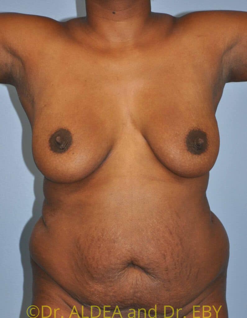 Before Image: Tummy Tuck #093 - front