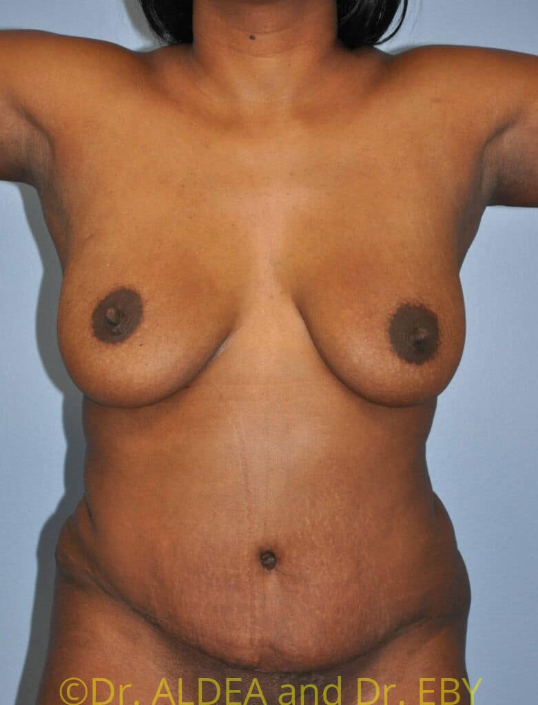 After Image: Tummy Tuck #093 - front