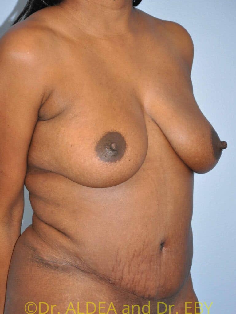 After Image: Tummy Tuck #093 - right-front-oblique