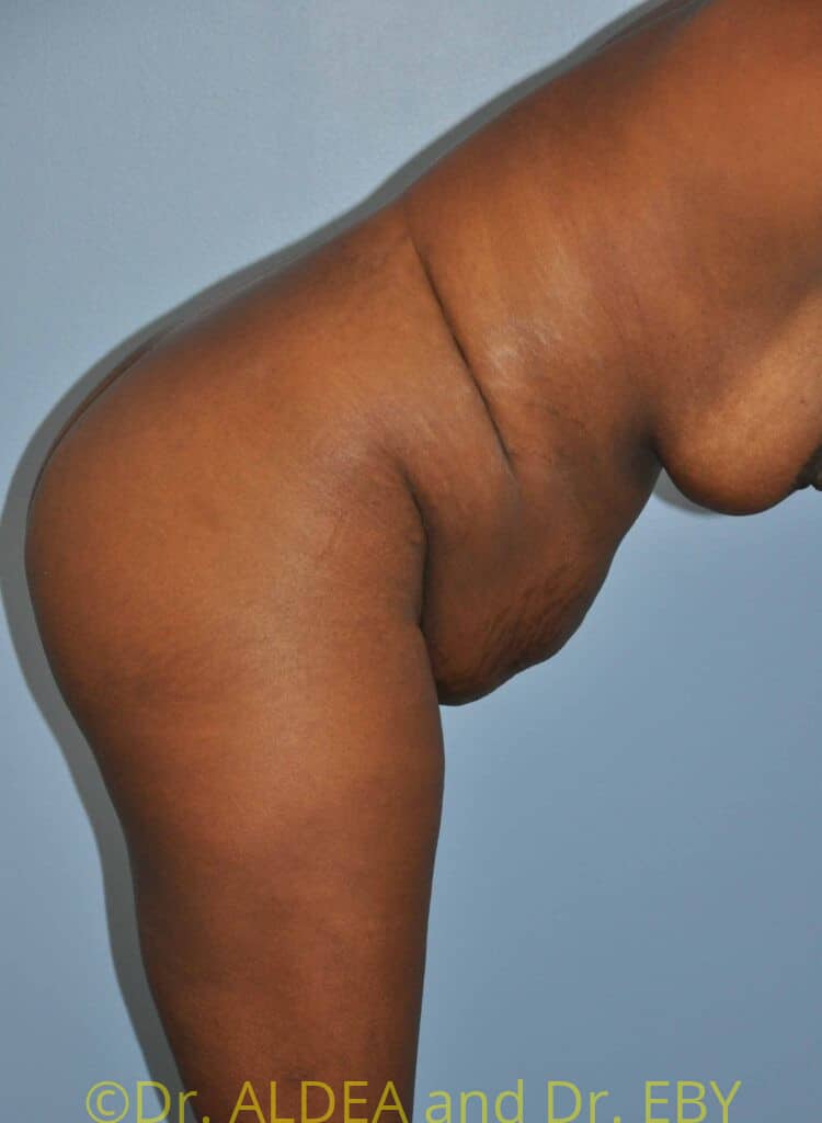 Before Image: Tummy Tuck #093 - other