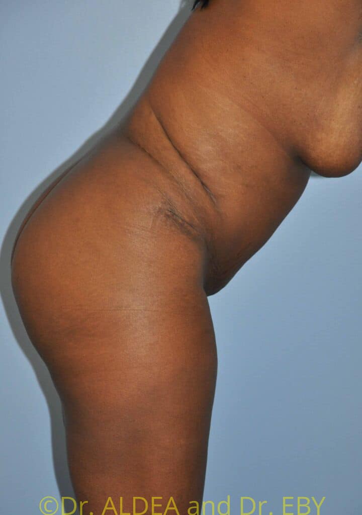 After Image: Tummy Tuck #093 - other