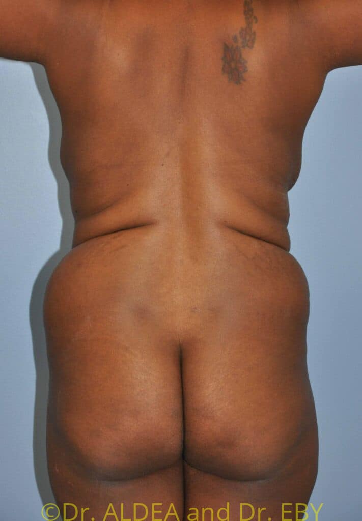 Before Image: Tummy Tuck #093 - back