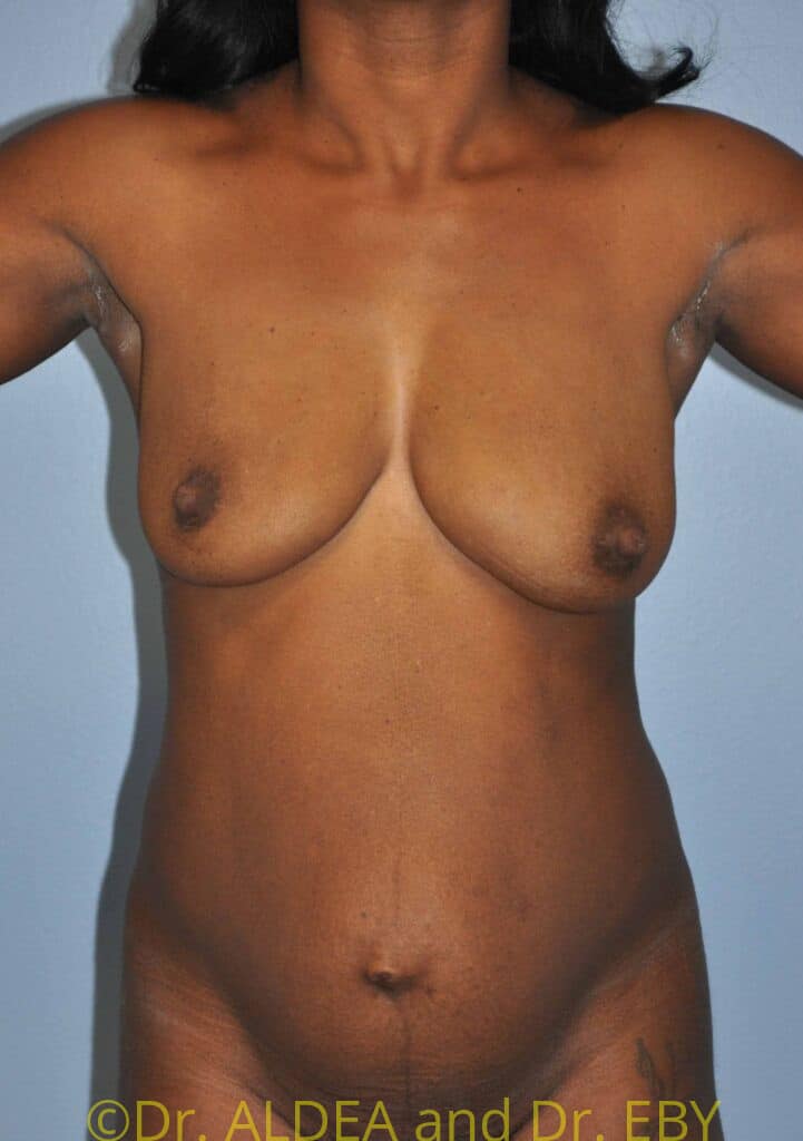 Before Image: Tummy Tuck #139 - front