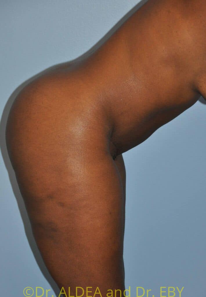 After Image: Tummy Tuck #875 - other