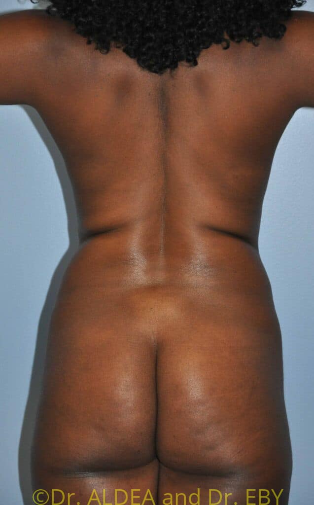 Before Image: Tummy Tuck #139 - back