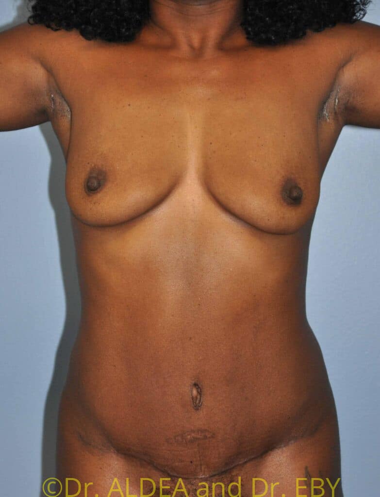 After Image: Tummy Tuck #139 - front