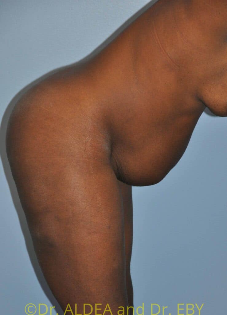 Before Image: Tummy Tuck #139 - other