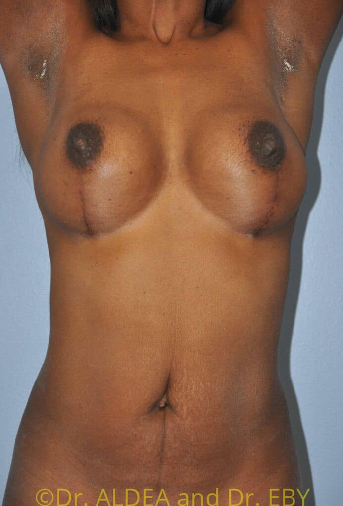 After Image: Breast Augmentation w/ Lift #209 - front