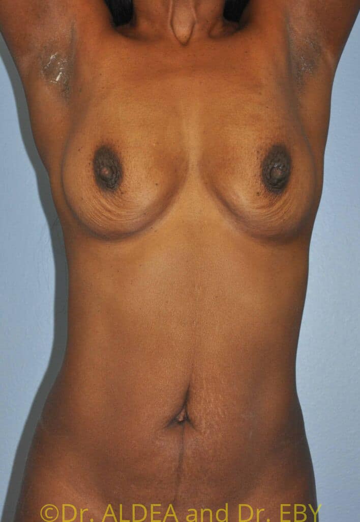 Before Image: Breast Augmentation w/ Lift #209 - front