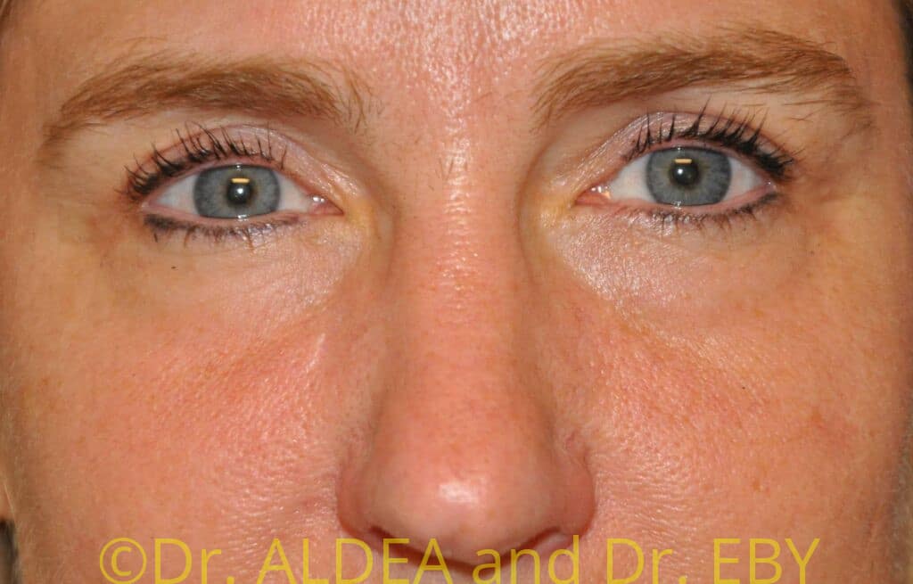 After Image: Blepharoplasty #547 - front