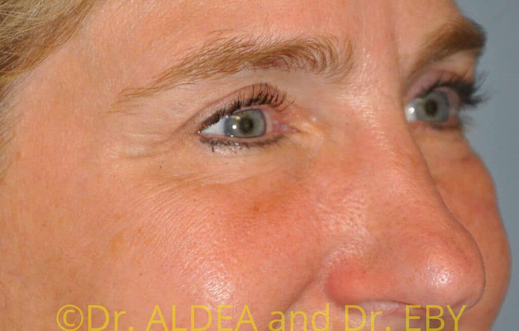 After Image: Blepharoplasty #547 - right-front-oblique