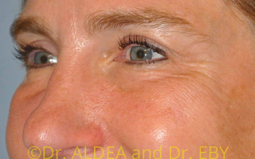 After Image: Blepharoplasty #547 - left-front-oblique