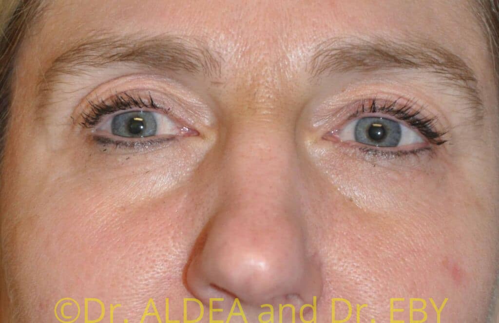 Before Image: Blepharoplasty #547 - front