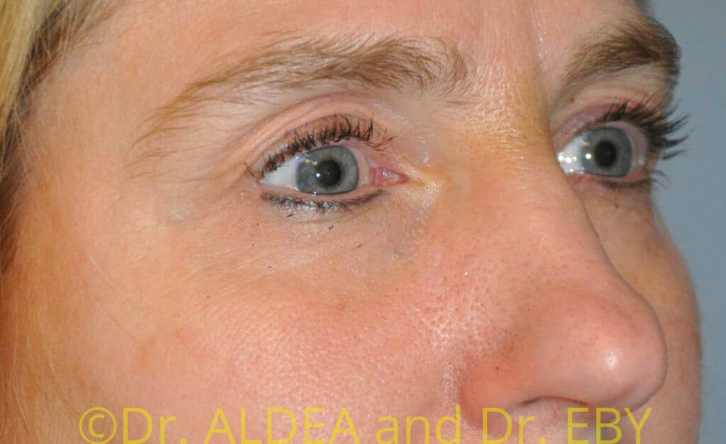 Before Image: Blepharoplasty #547 - right-front-oblique