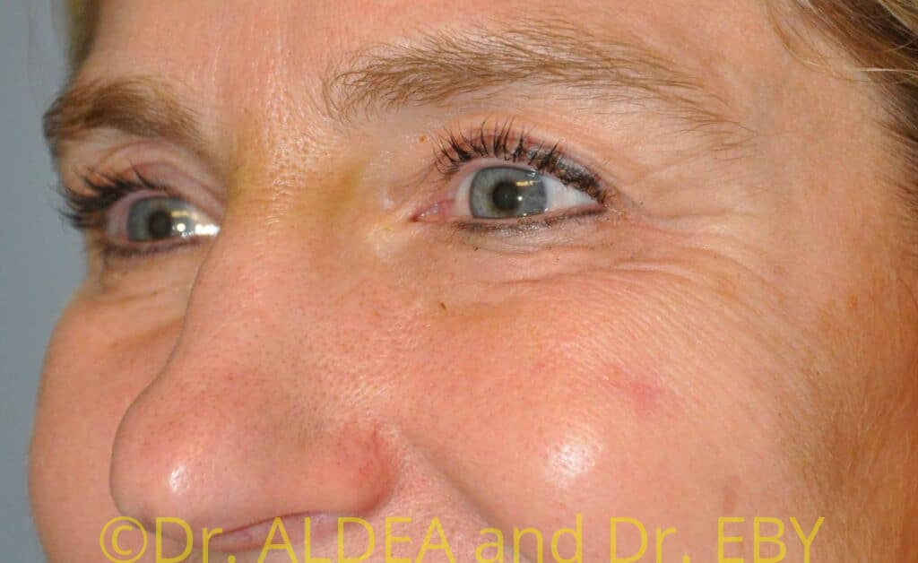 Before Image: Blepharoplasty #547 - left-front-oblique