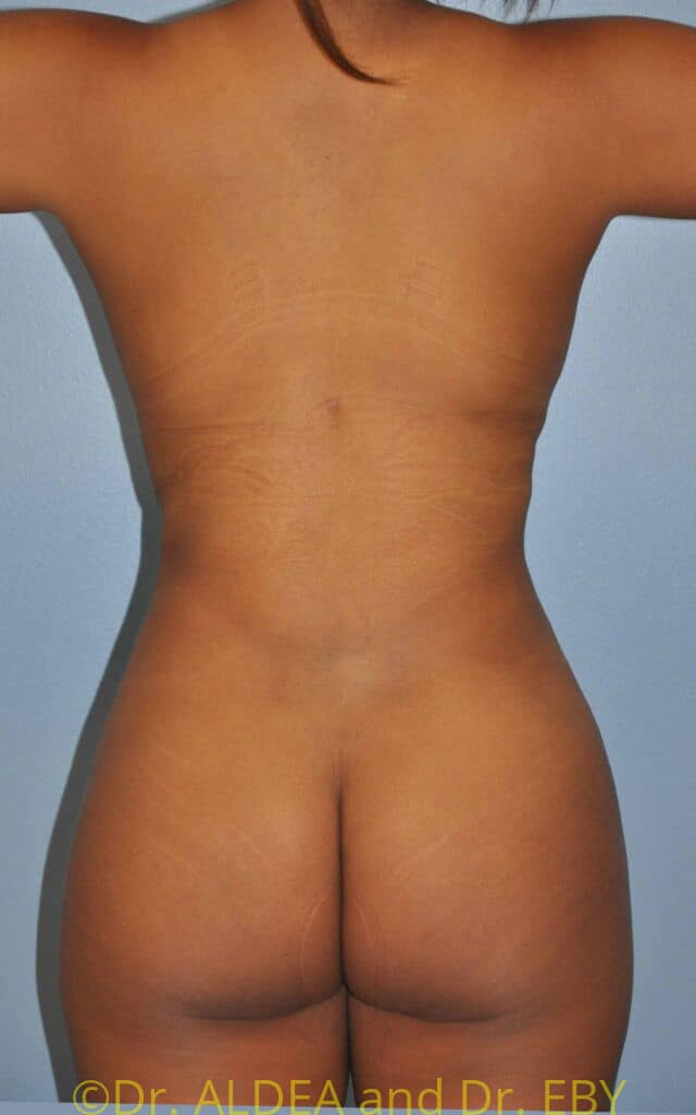 After Image: Back Scoop Liposuction #670 - back