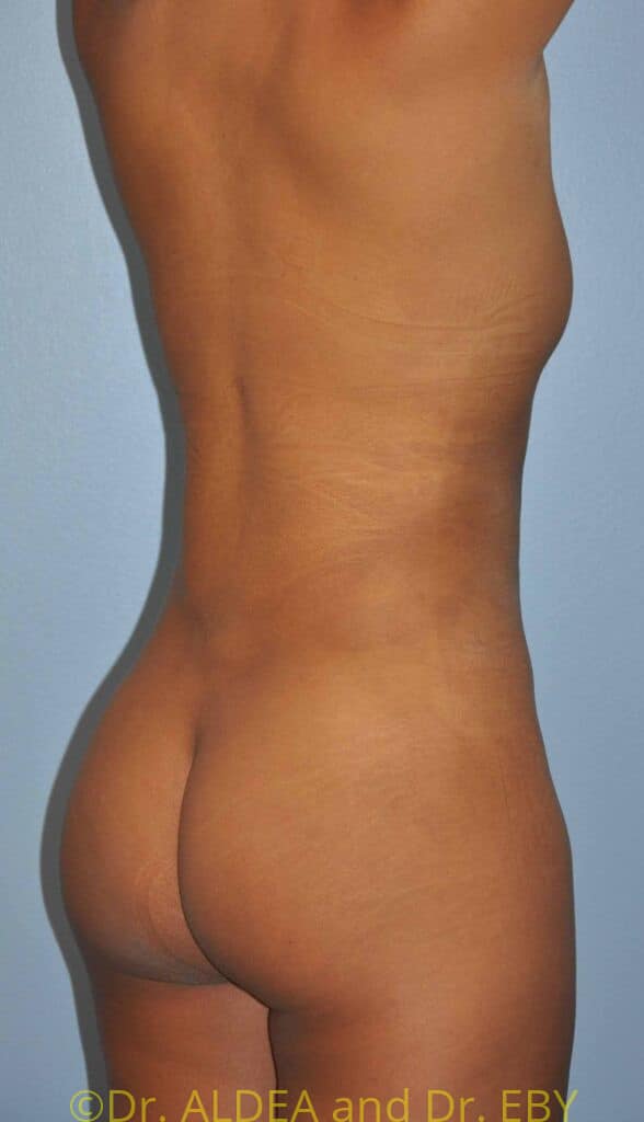 After Image: Back Scoop Liposuction #670 - right-back-oblique