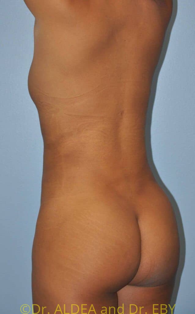 After Image: Back Scoop Liposuction #670 - left-back-oblique