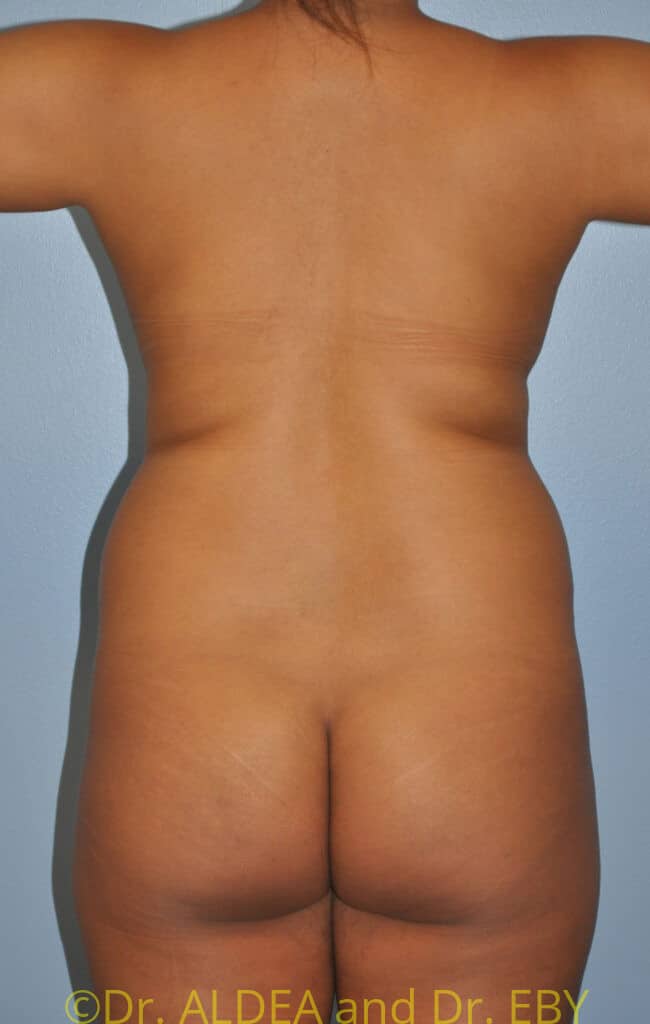 Before Image: Back Scoop Liposuction #670 - back