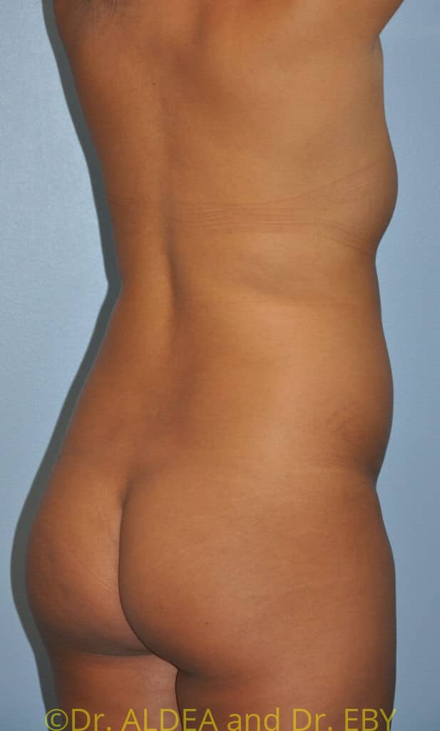 Before Image: Back Scoop Liposuction #670 - right-back-oblique
