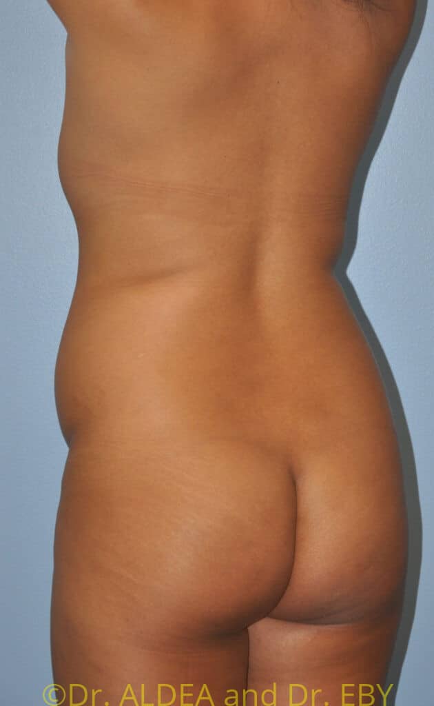 Before Image: Back Scoop Liposuction #670 - left-back-oblique