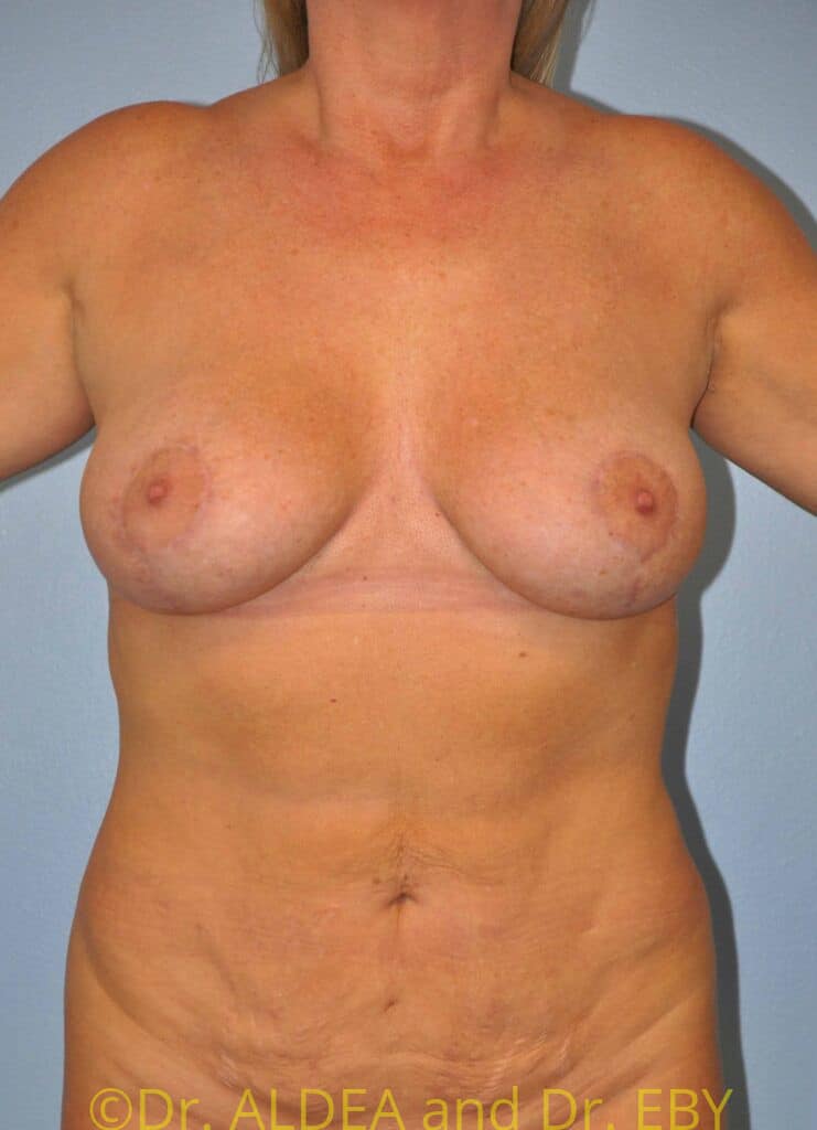 After Image: Short Scar Breast Lift (Mastopexy) #994 - front
