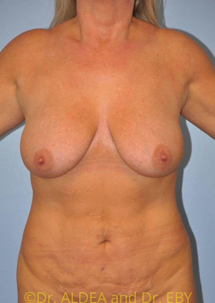 Before Image: Short Scar Breast Lift (Mastopexy) #994 - front