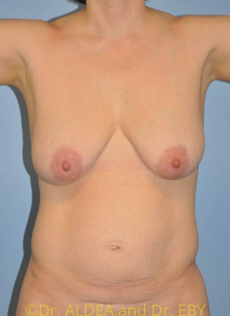 Before Image: Short Scar Breast Reduction #439 - front