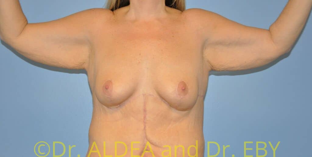 Before Image: Brachioplasty #297 - front
