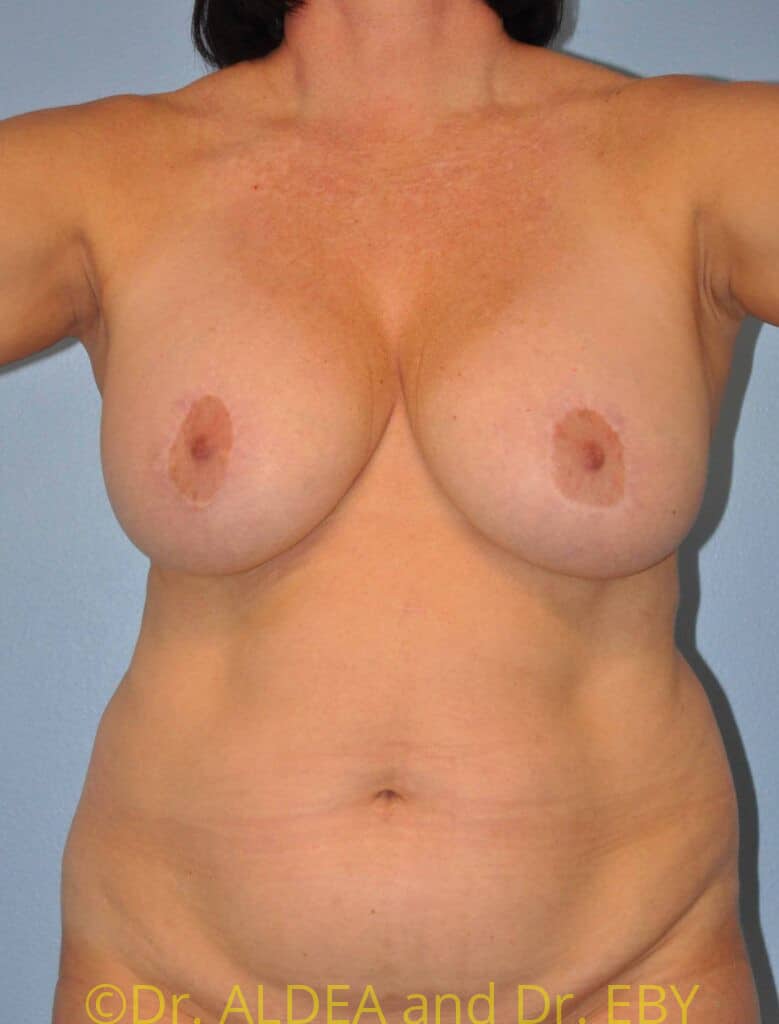 Before Image: Breast Implant Removal (Explantation) WITH a Lift #872 - front