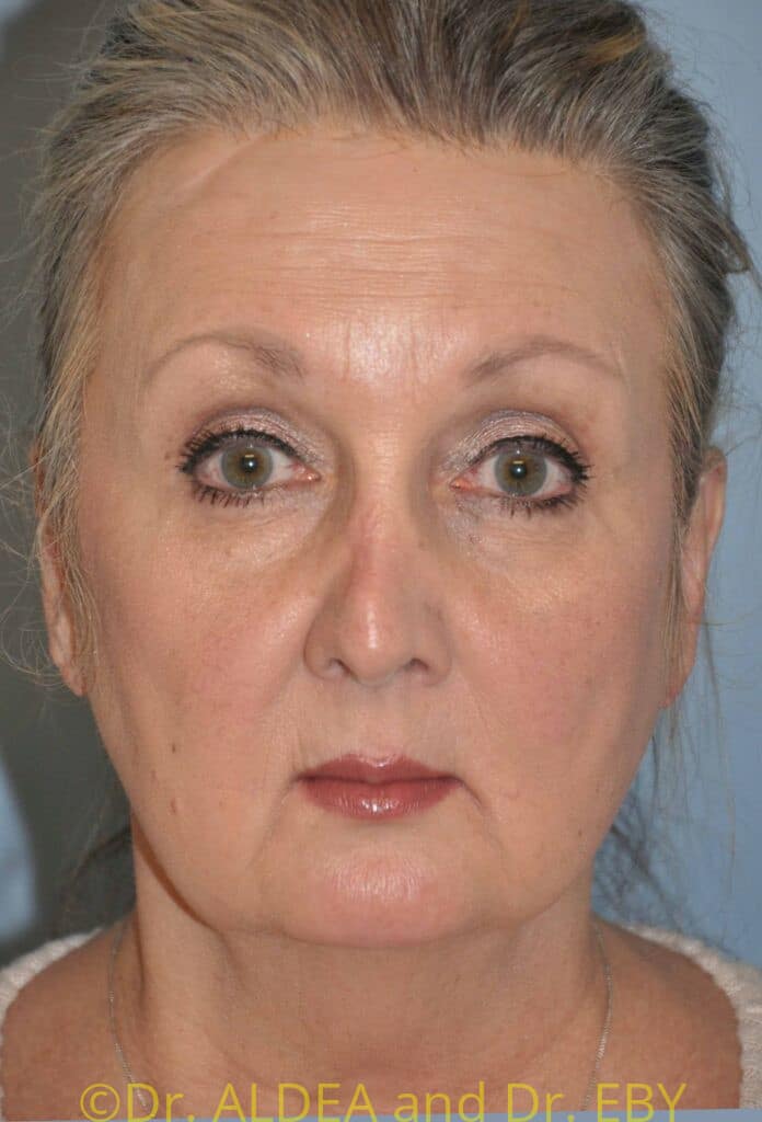 Before Image: Facelift #812 - front
