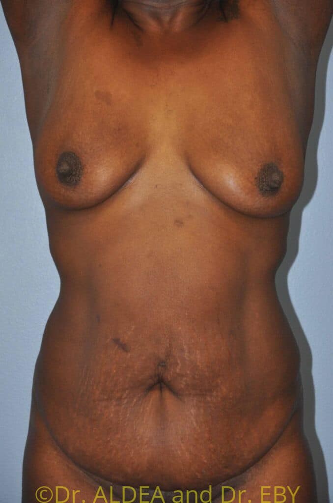 Before Image: Fat Transfer to Breasts #485 - front