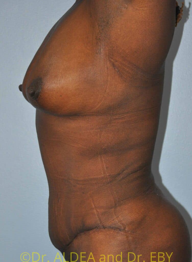 After Image: Fat Transfer to Breasts #485 - left-side