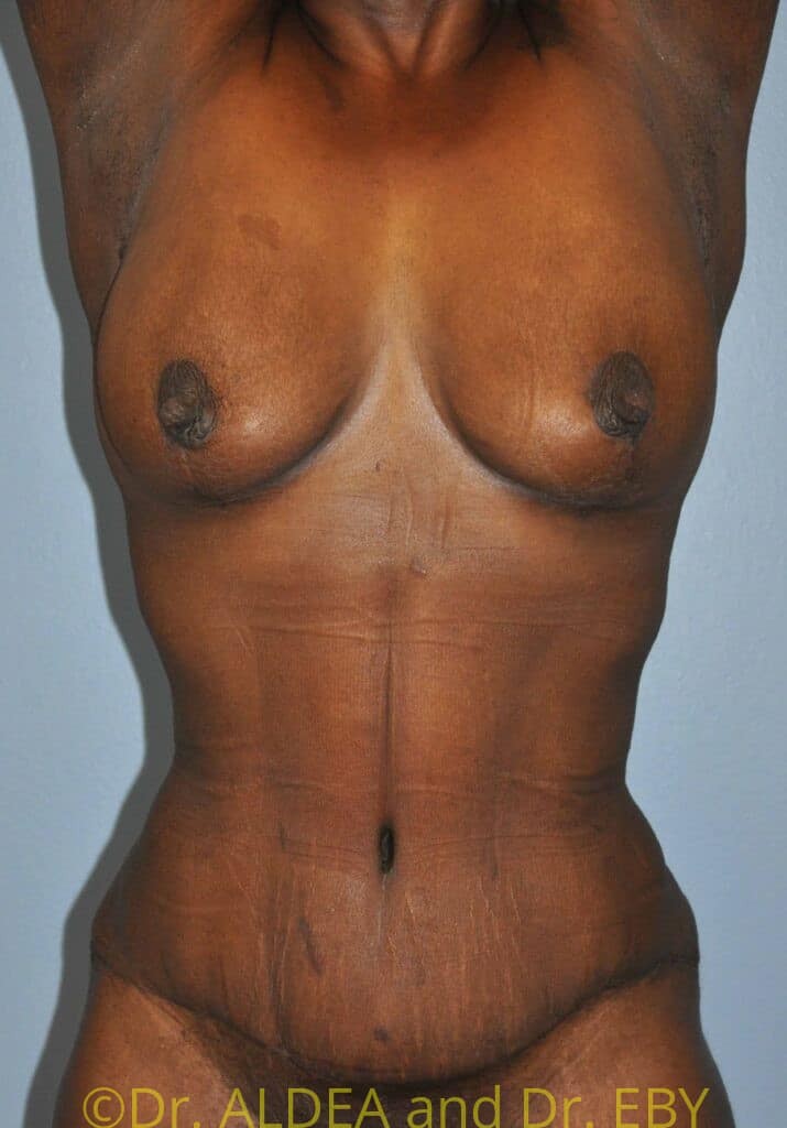 After Image: Fat Transfer to Breasts #485 - front