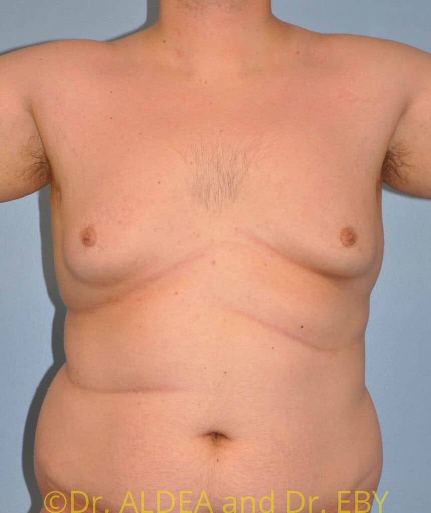 Before Image: Gynecomastia #139 - front