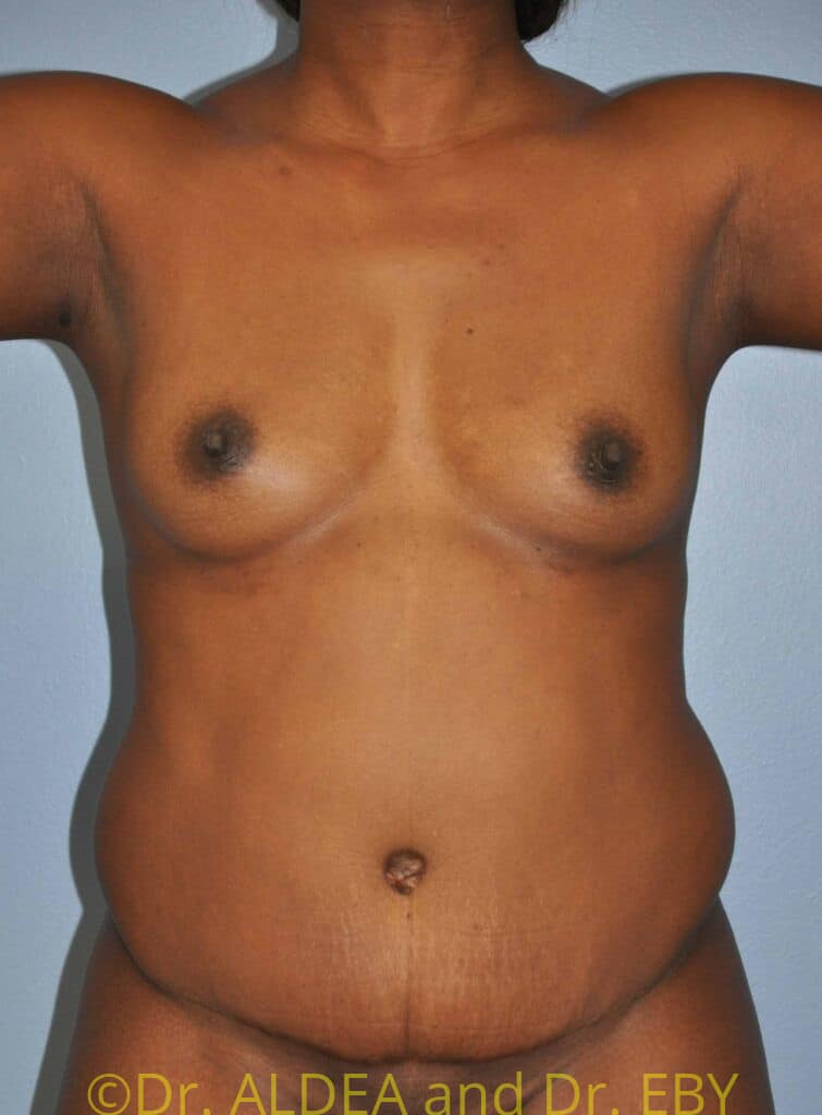 Before Image: Liposuction #280 - front