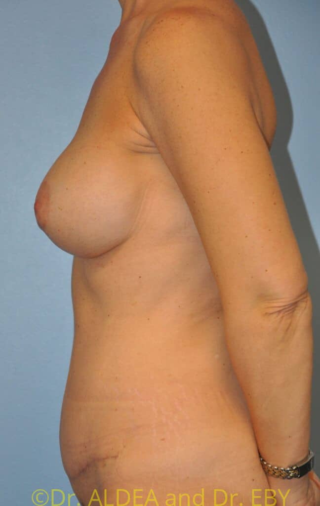 After Image: Mommy Makeover #103 - left-side
