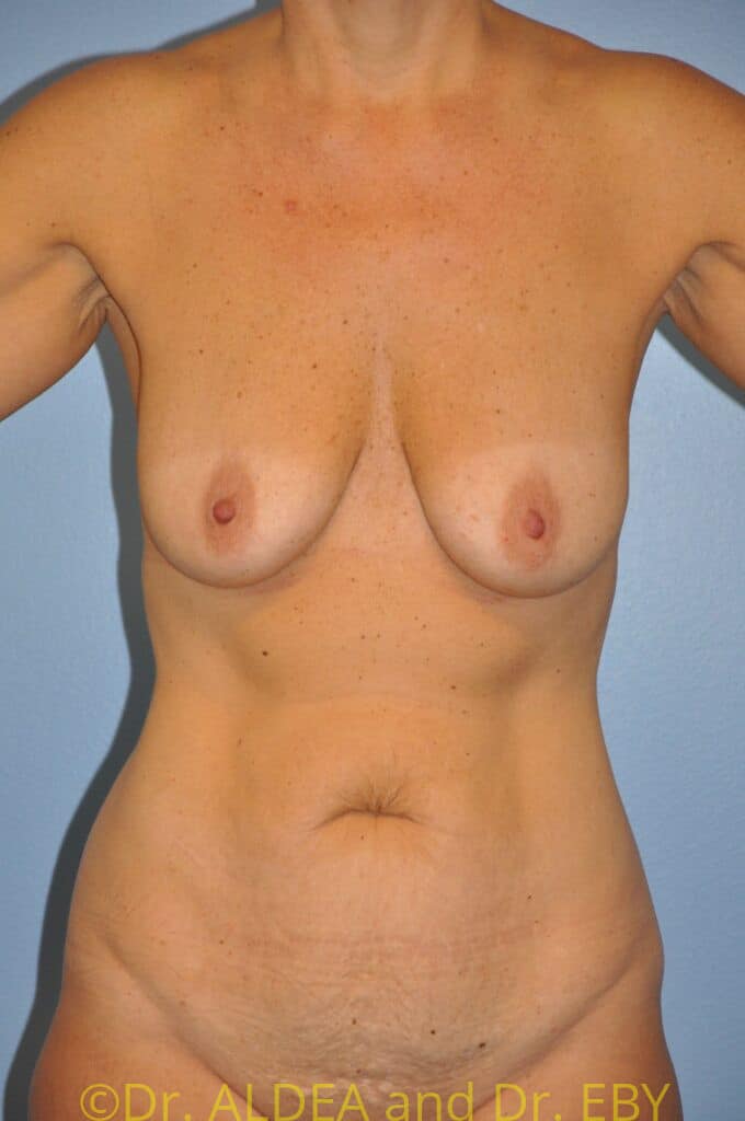 Before Image: Mommy Makeover #103 - front