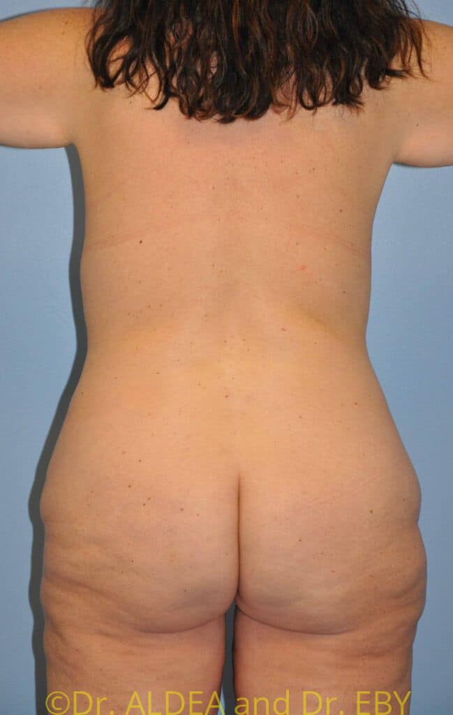 Before Image: Weight loss (MWL) Butt and Thigh Lift #416 - back