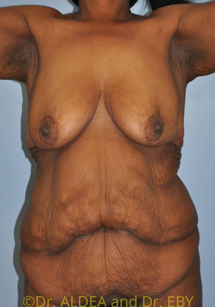 Before Image: Massive Weight Loss Tummy Tuck #887 - front