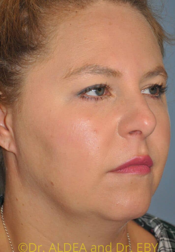 Before Image: Neck Liposuction #400 - right-front-oblique