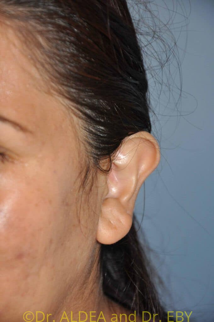 Before Image: Otoplasty (Prominent Ear Correction) #125 - left-front-oblique