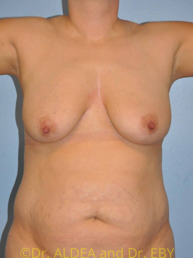 Before Image: Tummy Tuck #780 - front