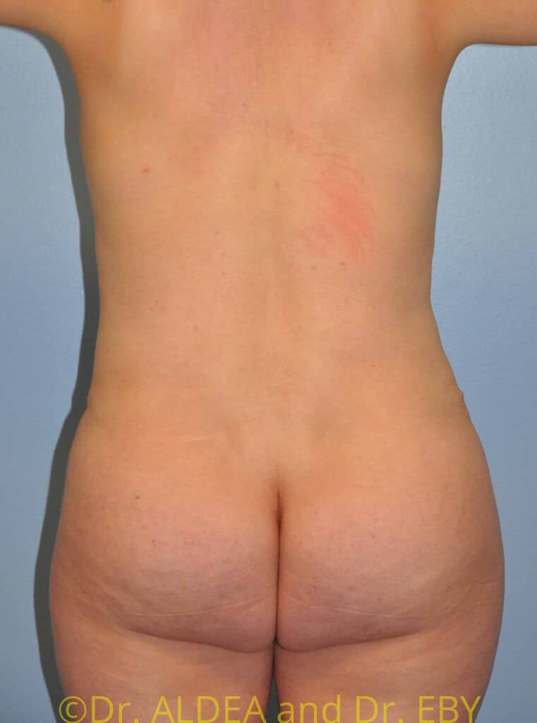 After Image: Tummy Tuck #780 - back