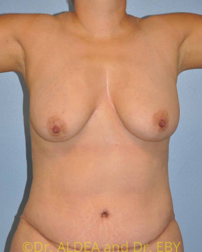 After Image: Tummy Tuck #780 - front