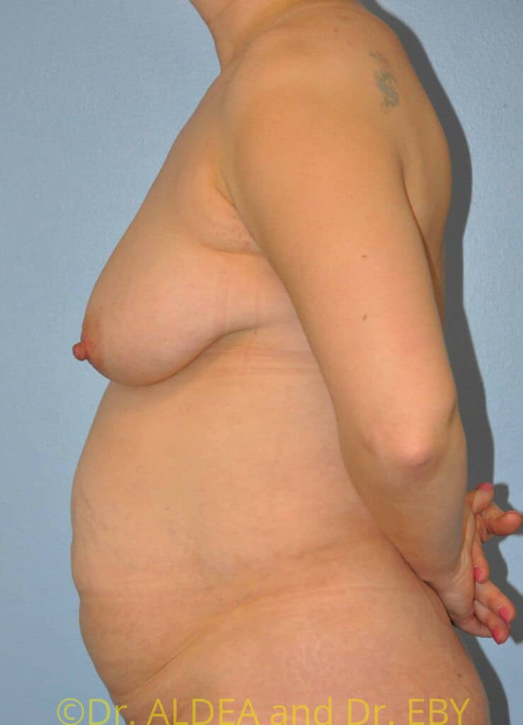 Before Image: Tummy Tuck #780 - left-side