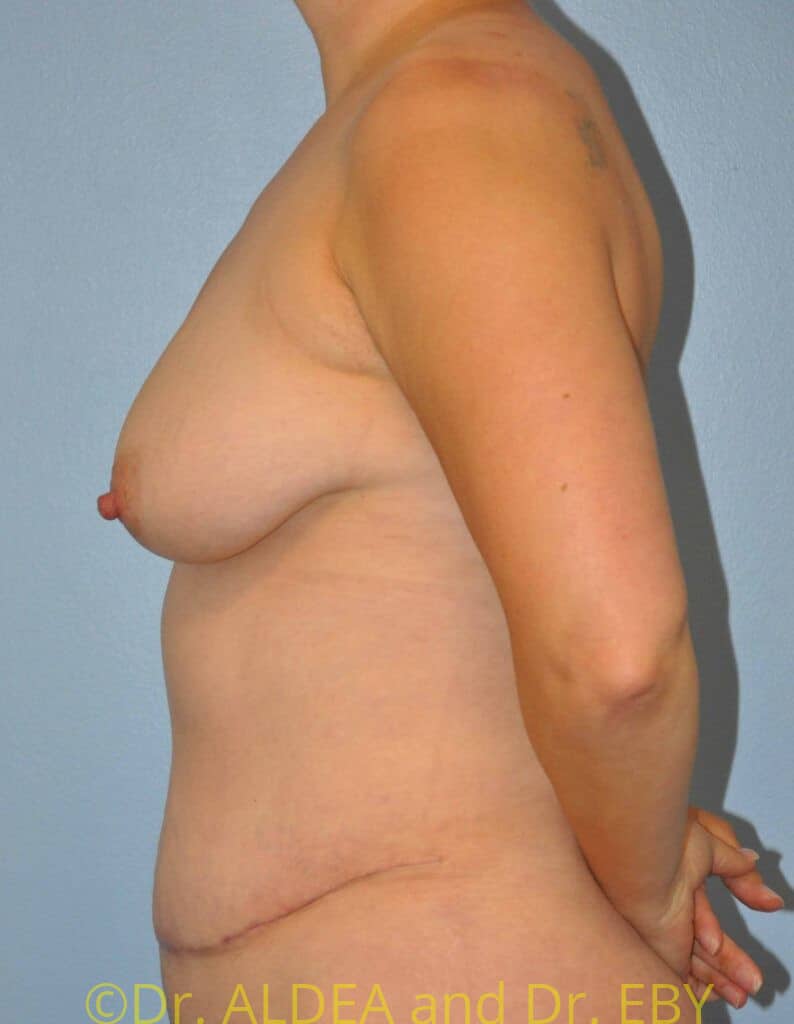 After Image: Tummy Tuck #780 - left-side