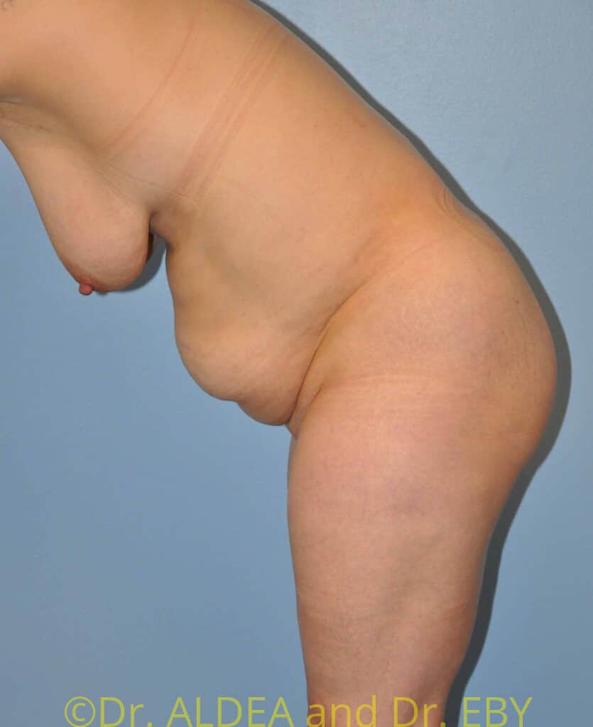 Before Image: Tummy Tuck #780 - other